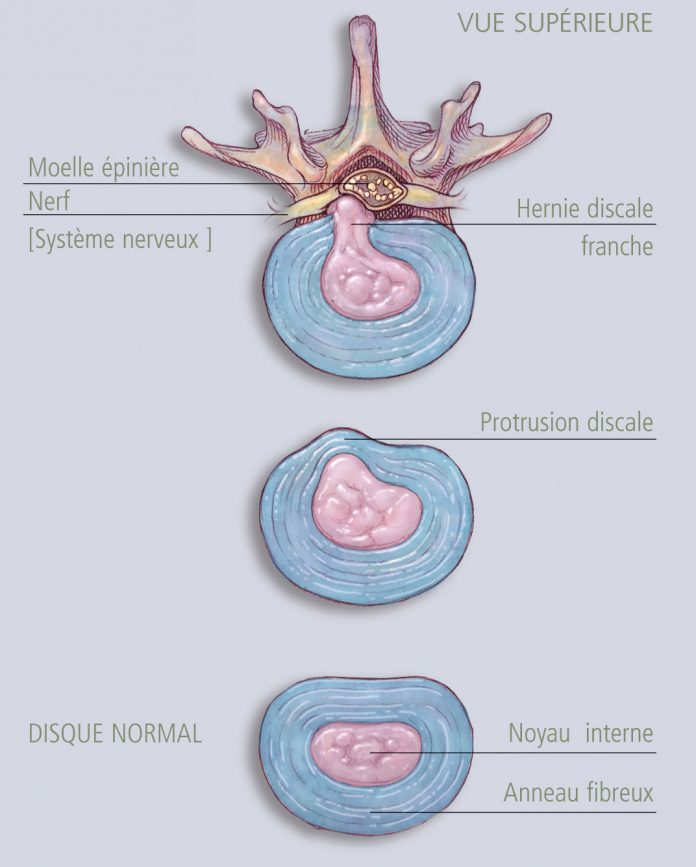 Symptôme hernie discale Bien réagir et identifier une crise rapidement